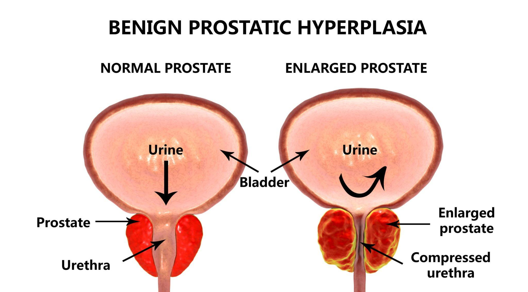 Understanding An Enlarged Prostate Symptoms Causes And Treatment Options 8238