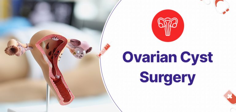 An In Depth Look At Ovarian Cyst Surgery 2355